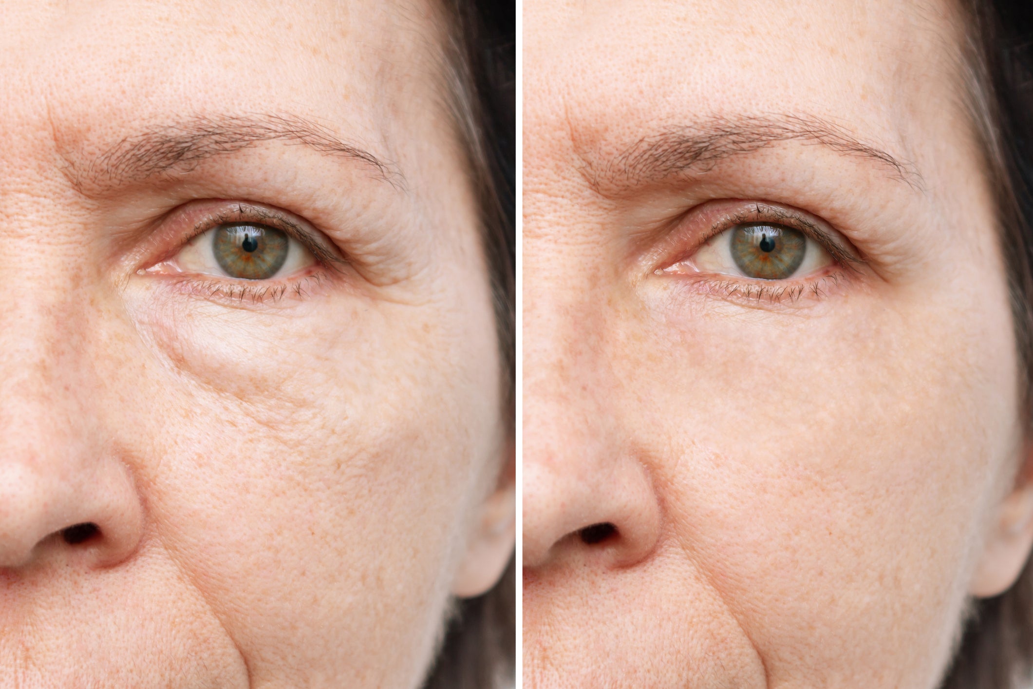 before and after picture of woman using anti wrinkle and anti puffiness revive gel